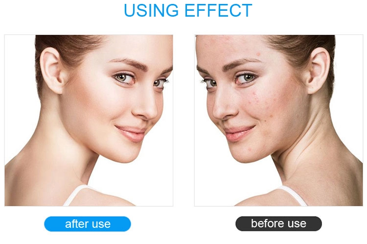 Ultraljudsskrubber för ansiktsrengöring av porer
